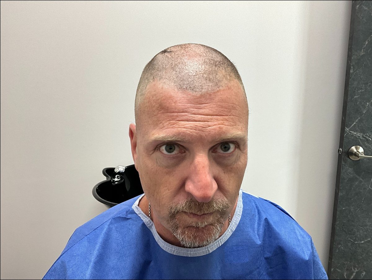 Hairline and frontal framing — front view — before