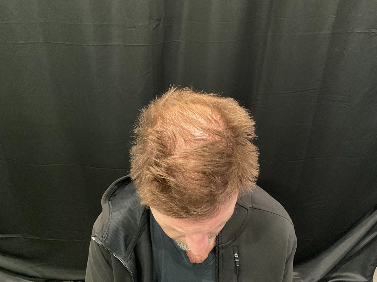 Crown and mid-scalp density — top view — after