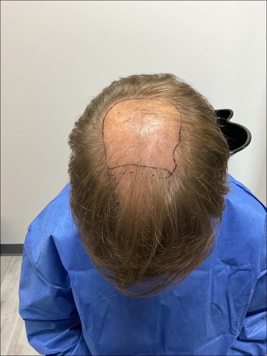 Crown and mid-scalp density — top view — before