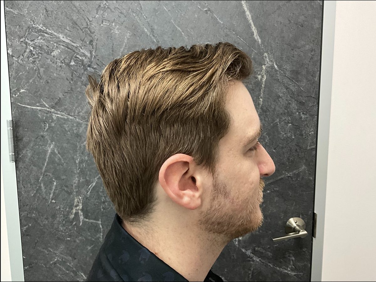 Temple and hairline restoration — side view — after