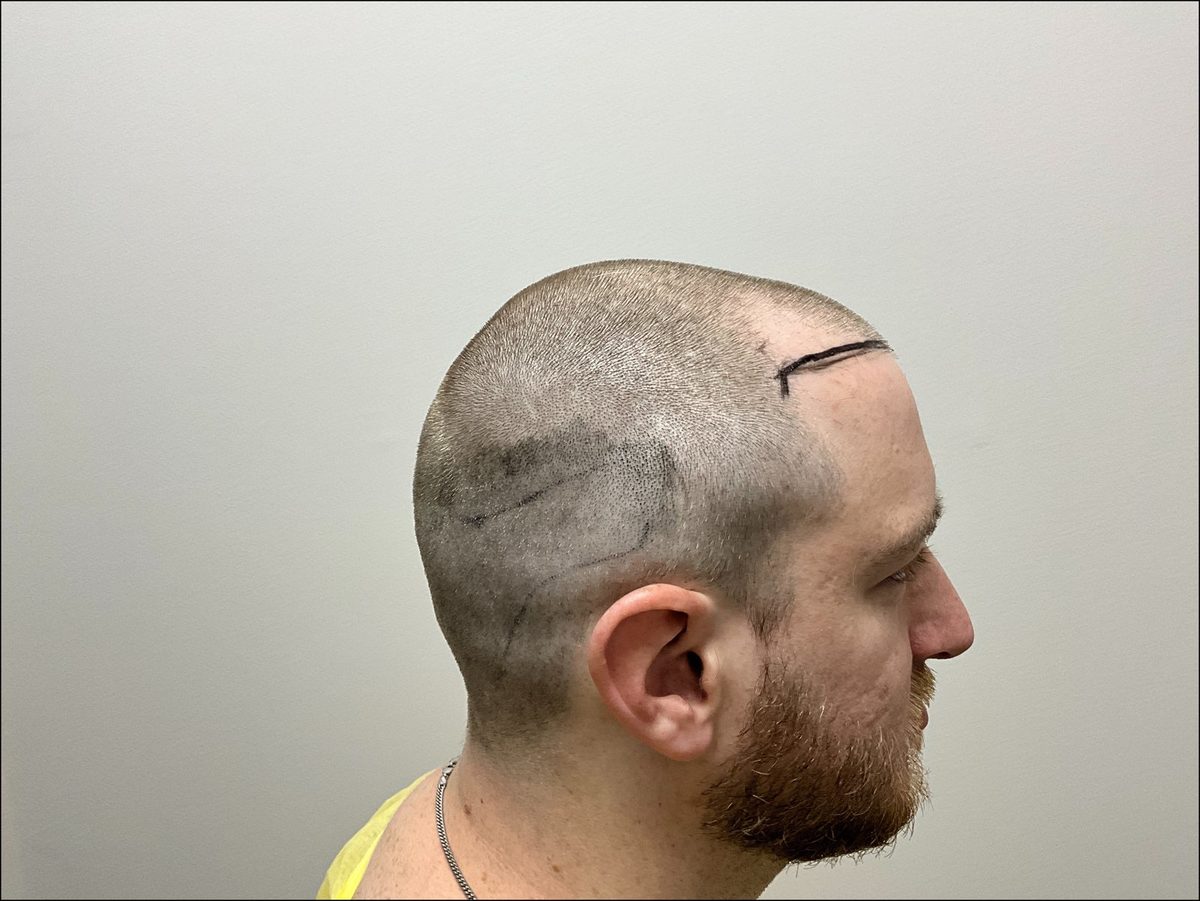 Temple and hairline restoration — side view — before