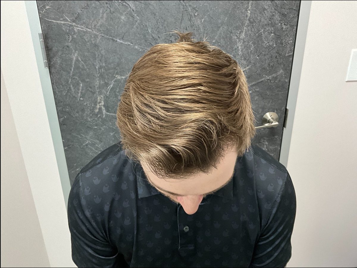 Frontal third and hairline rebuild — top view — after
