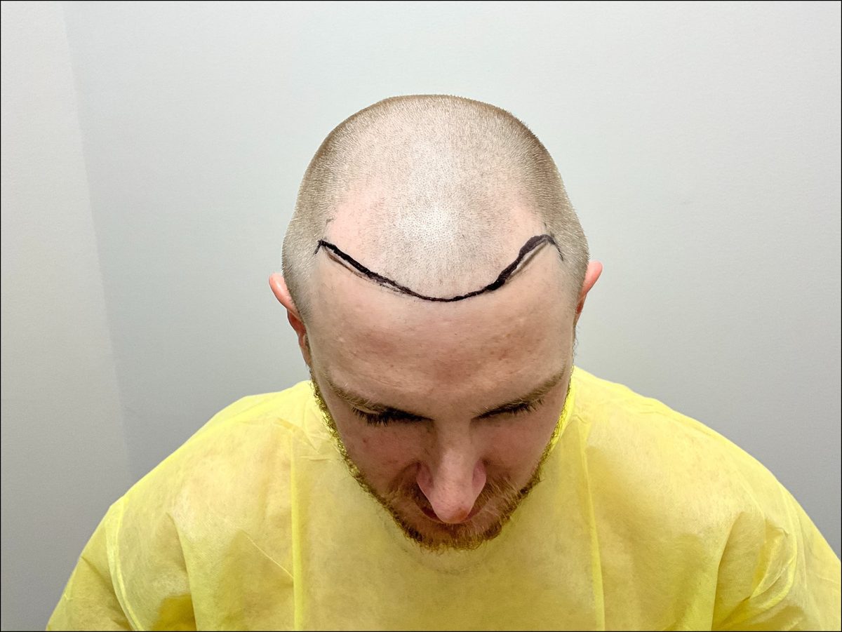 Frontal third and hairline rebuild — top view — before
