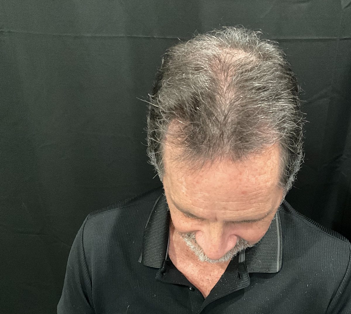 Crown and mid-scalp density — top view — after