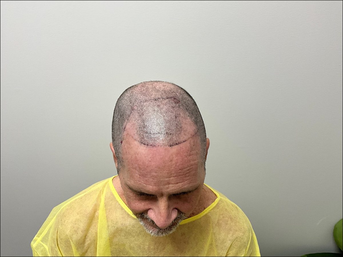 Crown and mid-scalp density — top view — before