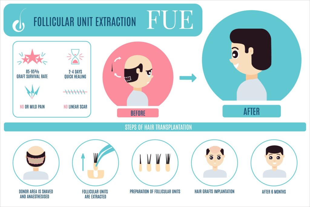 Follicular Unit Extraction 