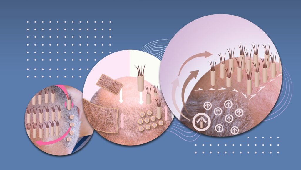 Precision hair restoration